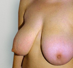 Breast Reduction Santa Barbara