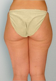 Liposuction Santa Barbara