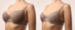 Breast Augmentation vs Breast Lift