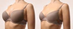 Breast Augmentation vs Breast Lift