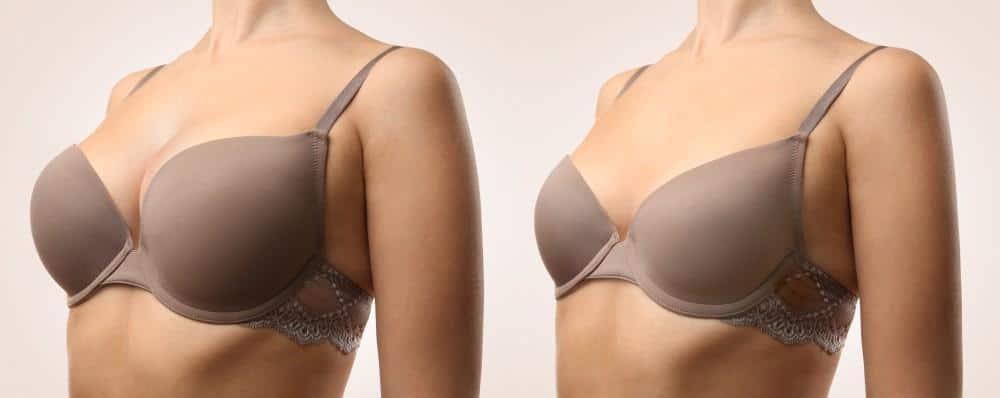 Breast Augmentation vs Breast Lift