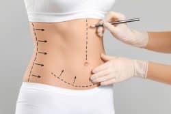 tummy tuck santa barbara