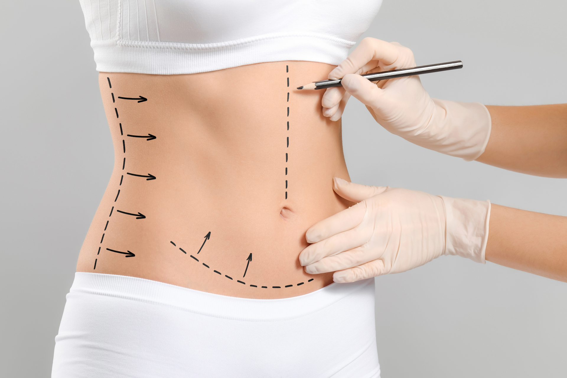 tummy tuck santa barbara