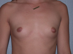 Breast Augmentation Before And After Santa Barbara