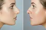 Rhinoplasty Santa Barbara
