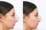 non-surgical nose fillers