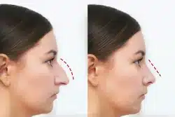 non-surgical nose fillers