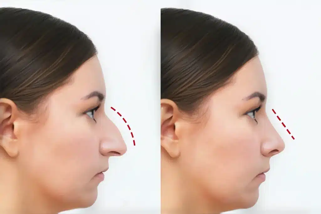 non-surgical nose fillers