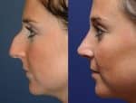 Rhinoplasty