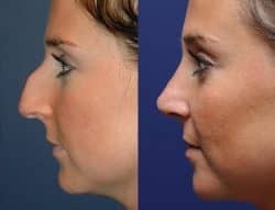 Rhinoplasty