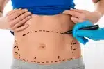 Tummy Tuck Candidacy