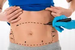 Tummy Tuck Candidacy