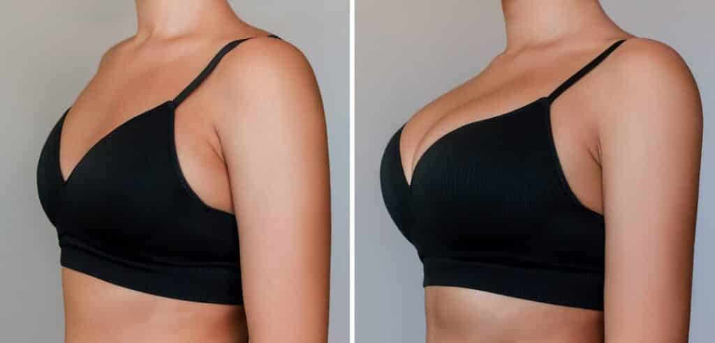 breast lift santa barbara