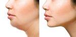chin augmentation santa barbara