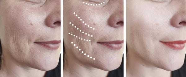 face lift in santa barbara