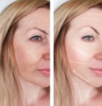 facelift results santa barbara
