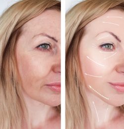 facelift results santa barbara