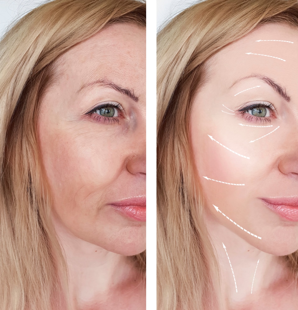 facelift results santa barbara