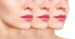 Lip Filler Santa Barbara