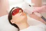 laser skin resurfacing santa barbara