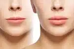 Modern Lip Lift