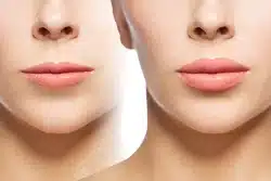 Modern Lip Lift