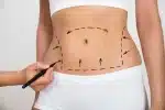 liposuction santa barbara