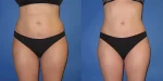 Liposuction in Santa Carpinteria