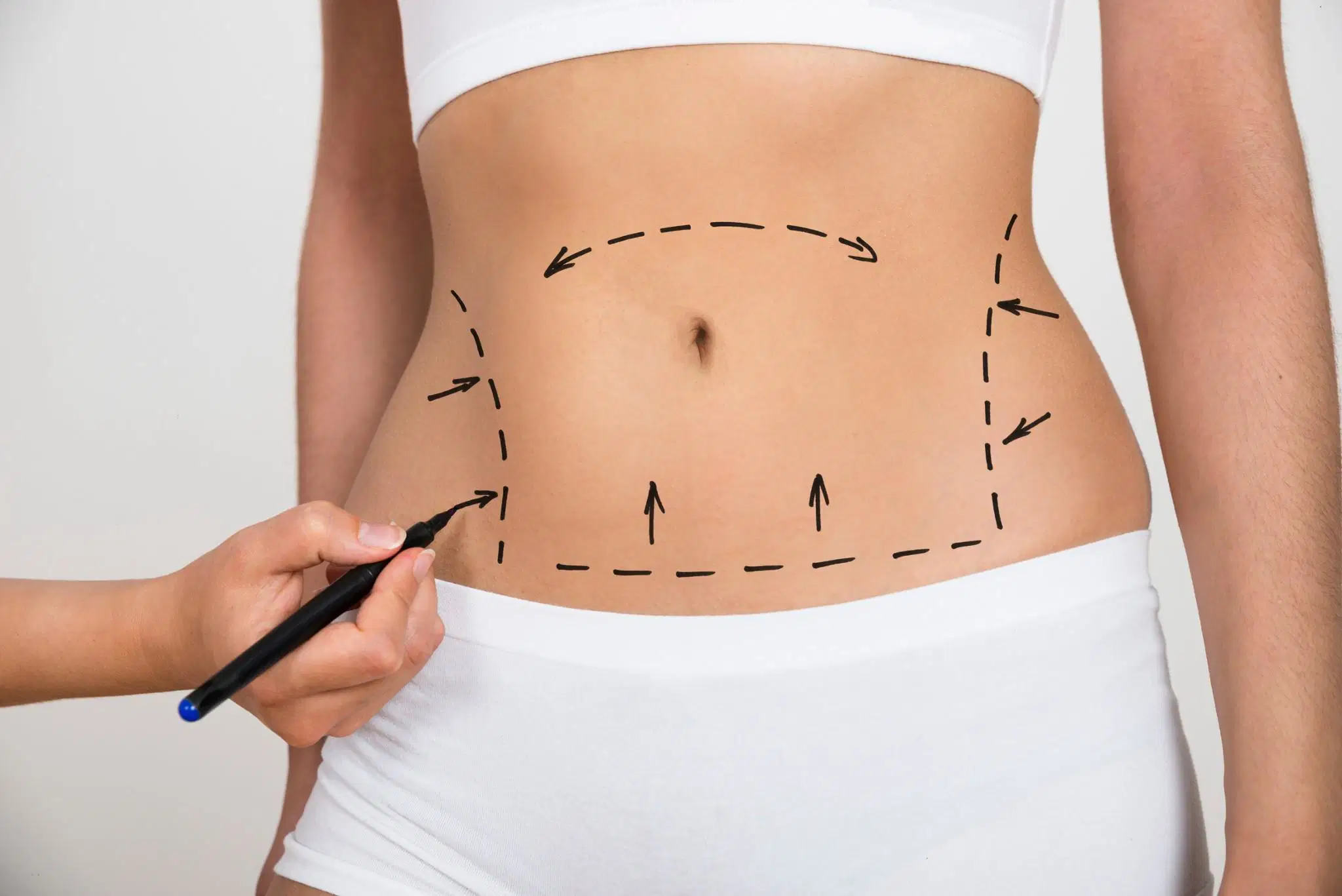 liposuction santa barbara
