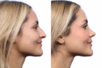 modern rhinoplasty
