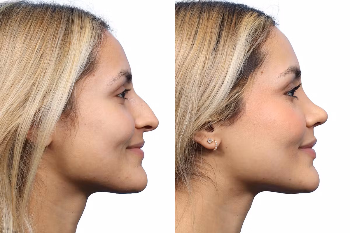 modern rhinoplasty
