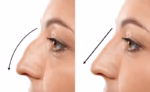 rhinoplasty cost santa barbara