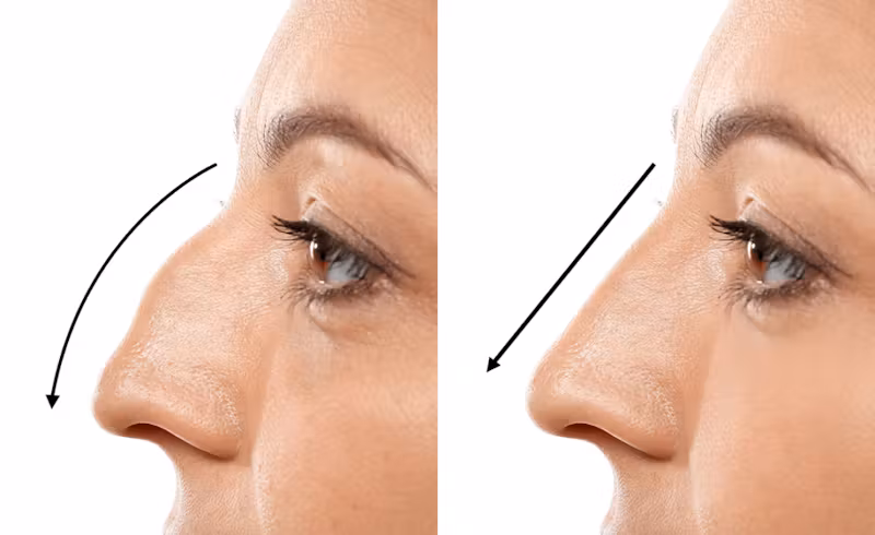 rhinoplasty cost santa barbara