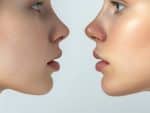 Chin Implants